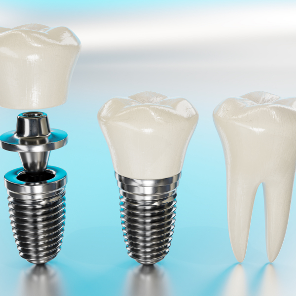The three parts of an implant (post, abutment and crown)
